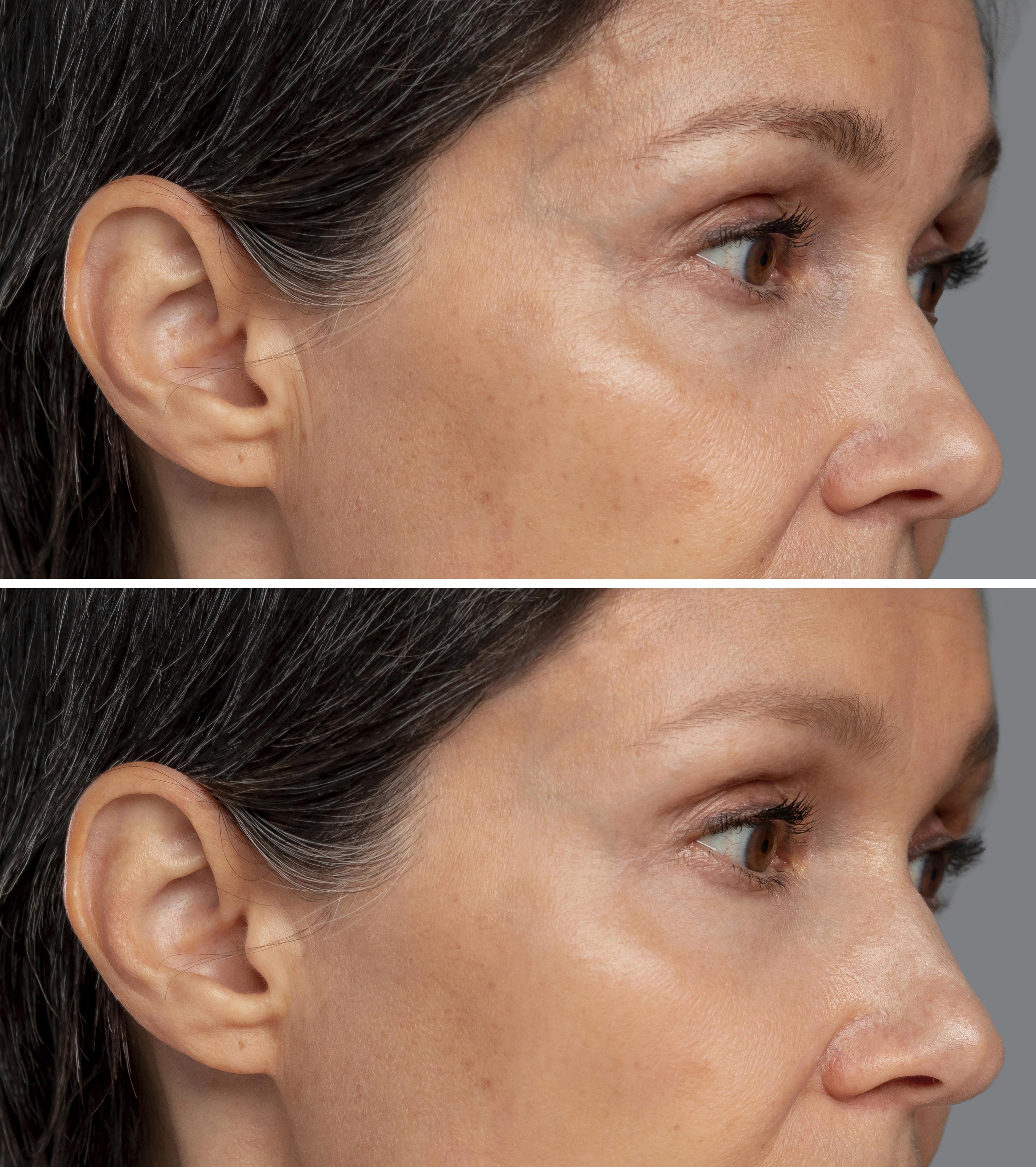 Hair Transplant in Madurai, hair clinic in Madurai, Skin Care in Madurai, Laser Treatment in Madurai, Hair Care in Madurai, hydra facial in Madurai, Hair Transplant near me, hair clinic near me, Skin Care near me, Hair Transplant in Madurai, best hair clinic in Madurai, best hydra facial in Madurai,  best hair transplantation clinic in madurai, best laser unwanted hair removal in Madurai, Best Hair Restoration in Madurai, Best Hair Replacement in Madurai, Best Hair Transplant Surgery in Madurai, Best Hair Loss Treatment in Madurai, Best Hair Grafting in Madurai, Best Hair Regrowth in Madurai, Best Hair Loss Solutions in Madurai, Best Hair Transplant Clinics in Madurai, Best Baldness Treatment in Madurai, Best Hair Transplant Recovery in Madurai, Best Hair Transplant Cost in Madurai, Best Hairline Restoration in Madurai, Best Scalp Treatments in Madurai, Best Hair Thinning Solutions in Madurai, Best skin clinic in madurai, Best laser treatment in madurai, best acne scar treatment in madurai, Best chemical peels in madurai , Best laser tattoo removal clinic in madurai , Best hair fall treatment clinic in madurai , best laser skin rejuvenation clinic in madurai , Best laser scar reduction clinic in madurai, best skin brightening treatment in Madurai, Best Hair Regrowth in Madurai, Best Hair Loss Solutions in Madurai, Best Hair Transplant Clinics in Madurai, Best Baldness Treatment in Madurai, Best Hair Transplant Recovery in Madurai, Best Hair Transplant Cost in Madurai, Best Hairline Restoration in Madurai, Best Scalp Treatments in Madurai, Best Hair Thinning Solutions in Madurai, Best Hair Transplant Before and After in Madurai, Best Hair Transplant Consultation in Madurai, Laser Hair Removal in Madurai, Laser Skin Therapy in Madurai, Laser Skin Resurfacing in Madurai, Best Follicular Unit Transplantation (FUT) in Madurai, Best Follicular Unit Extraction (FUE) in Madurai, Best Scalp Micropigmentation in Madurai, Best  Dark Circle Solutions in Madurai, Black Eye Treatment  in Madurai, Best Beauty Therapist in Madurai, Color-Centric Skincare in Madurai, Hue-Based Skin Treatment in Madurai, Skincare for All Hues in Madurai, Skin Care for Diverse Hues in Madurai, Skin Tone-Specific Treatments in Madurai, Skincare Solutions for Every Hue in Madurai, Hue-Specific Dermatology in Madurai, Skincare by Skin Tone in Madurai, Tailored Skin Treatment for Hues in Madurai, Personalized Skincare by Hues in Madurai, Skin Care for Various Hues in Madurai, Color-Based Skin Care in Madurai, Skin Health for All Tones in Madurai, Laser Skin Tightening in Madurai, Laser Wrinkle Reduction in Madurai, Laser Scar Removal in Madurai, Laser Pigmentation Treatment in Madurai, Laser Acne Treatment in Madurai, Laser Skin Rejuvenation in Madurai, Laser Tattoo Removal in Madurai, Non-Invasive Laser Treatment in Madurai, Laser Skin Care in Madurai, Medical Laser Treatment in Madurai, Laser Dermatology in Madurai, Advanced Laser Therapy in Madurai, Cosmetic Laser Procedures in Madurai, Laser Anti-Aging in Madurai, Fractional Laser Treatment in Madurai, Laser Treatment Recovery in Madurai, Hair Treatment in Madurai, Hair Restoration in Madurai, Hair Health in Madurai, Hair Growth in Madurai, Hair Repair in Madurai, Hair Loss Prevention in Madurai, Hair Conditioning in Madurai, Hair Strengthening in Madurai, Scalp Treatment in Madurai, Hair Moisturization in Madurai, Split Ends Repair in Madurai, Natural Hair Treatments in Madurai, Hair Coloring in Madurai, Heat Damage Repair in Madurai, Hair Masks in Madurai, Organic Hair Care in Madurai, Hair Shine in Madurai, Frizz Control in Madurai, Hair Serums in Madurai.