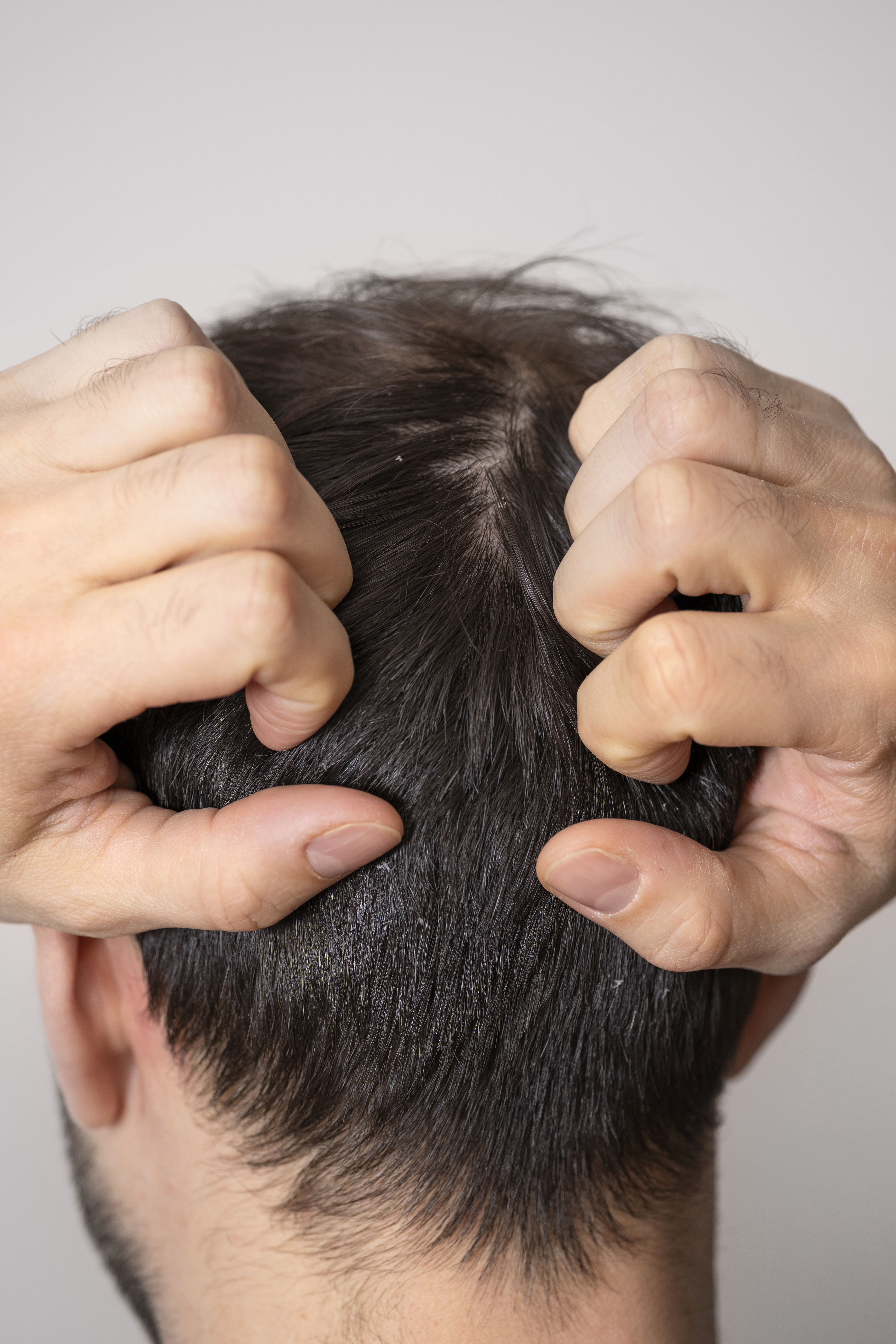 Hair Transplant in Madurai, hair clinic in Madurai, Skin Care in Madurai, Laser Treatment in Madurai, Hair Care in Madurai, hydra facial in Madurai, Hair Transplant near me, hair clinic near me, Skin Care near me, Hair Transplant in Madurai, best hair clinic in Madurai, best hydra facial in Madurai,  best hair transplantation clinic in madurai, best laser unwanted hair removal in Madurai, Best Hair Restoration in Madurai, Best Hair Replacement in Madurai, Best Hair Transplant Surgery in Madurai, Best Hair Loss Treatment in Madurai, Best Hair Grafting in Madurai, Best Hair Regrowth in Madurai, Best Hair Loss Solutions in Madurai, Best Hair Transplant Clinics in Madurai, Best Baldness Treatment in Madurai, Best Hair Transplant Recovery in Madurai, Best Hair Transplant Cost in Madurai, Best Hairline Restoration in Madurai, Best Scalp Treatments in Madurai, Best Hair Thinning Solutions in Madurai, Best skin clinic in madurai, Best laser treatment in madurai, best acne scar treatment in madurai, Best chemical peels in madurai , Best laser tattoo removal clinic in madurai , Best hair fall treatment clinic in madurai , best laser skin rejuvenation clinic in madurai , Best laser scar reduction clinic in madurai, best skin brightening treatment in Madurai, Best Hair Regrowth in Madurai, Best Hair Loss Solutions in Madurai, Best Hair Transplant Clinics in Madurai, Best Baldness Treatment in Madurai, Best Hair Transplant Recovery in Madurai, Best Hair Transplant Cost in Madurai, Best Hairline Restoration in Madurai, Best Scalp Treatments in Madurai, Best Hair Thinning Solutions in Madurai, Best Hair Transplant Before and After in Madurai, Best Hair Transplant Consultation in Madurai, Laser Hair Removal in Madurai, Laser Skin Therapy in Madurai, Laser Skin Resurfacing in Madurai, Best Follicular Unit Transplantation (FUT) in Madurai, Best Follicular Unit Extraction (FUE) in Madurai, Best Scalp Micropigmentation in Madurai, Best  Dark Circle Solutions in Madurai, Black Eye Treatment  in Madurai, Best Beauty Therapist in Madurai, Color-Centric Skincare in Madurai, Hue-Based Skin Treatment in Madurai, Skincare for All Hues in Madurai, Skin Care for Diverse Hues in Madurai, Skin Tone-Specific Treatments in Madurai, Skincare Solutions for Every Hue in Madurai, Hue-Specific Dermatology in Madurai, Skincare by Skin Tone in Madurai, Tailored Skin Treatment for Hues in Madurai, Personalized Skincare by Hues in Madurai, Skin Care for Various Hues in Madurai, Color-Based Skin Care in Madurai, Skin Health for All Tones in Madurai, Laser Skin Tightening in Madurai, Laser Wrinkle Reduction in Madurai, Laser Scar Removal in Madurai, Laser Pigmentation Treatment in Madurai, Laser Acne Treatment in Madurai, Laser Skin Rejuvenation in Madurai, Laser Tattoo Removal in Madurai, Non-Invasive Laser Treatment in Madurai, Laser Skin Care in Madurai, Medical Laser Treatment in Madurai, Laser Dermatology in Madurai, Advanced Laser Therapy in Madurai, Cosmetic Laser Procedures in Madurai, Laser Anti-Aging in Madurai, Fractional Laser Treatment in Madurai, Laser Treatment Recovery in Madurai, Hair Treatment in Madurai, Hair Restoration in Madurai, Hair Health in Madurai, Hair Growth in Madurai, Hair Repair in Madurai, Hair Loss Prevention in Madurai, Hair Conditioning in Madurai, Hair Strengthening in Madurai, Scalp Treatment in Madurai, Hair Moisturization in Madurai, Split Ends Repair in Madurai, Natural Hair Treatments in Madurai, Hair Coloring in Madurai, Heat Damage Repair in Madurai, Hair Masks in Madurai, Organic Hair Care in Madurai, Hair Shine in Madurai, Frizz Control in Madurai, Hair Serums in Madurai.