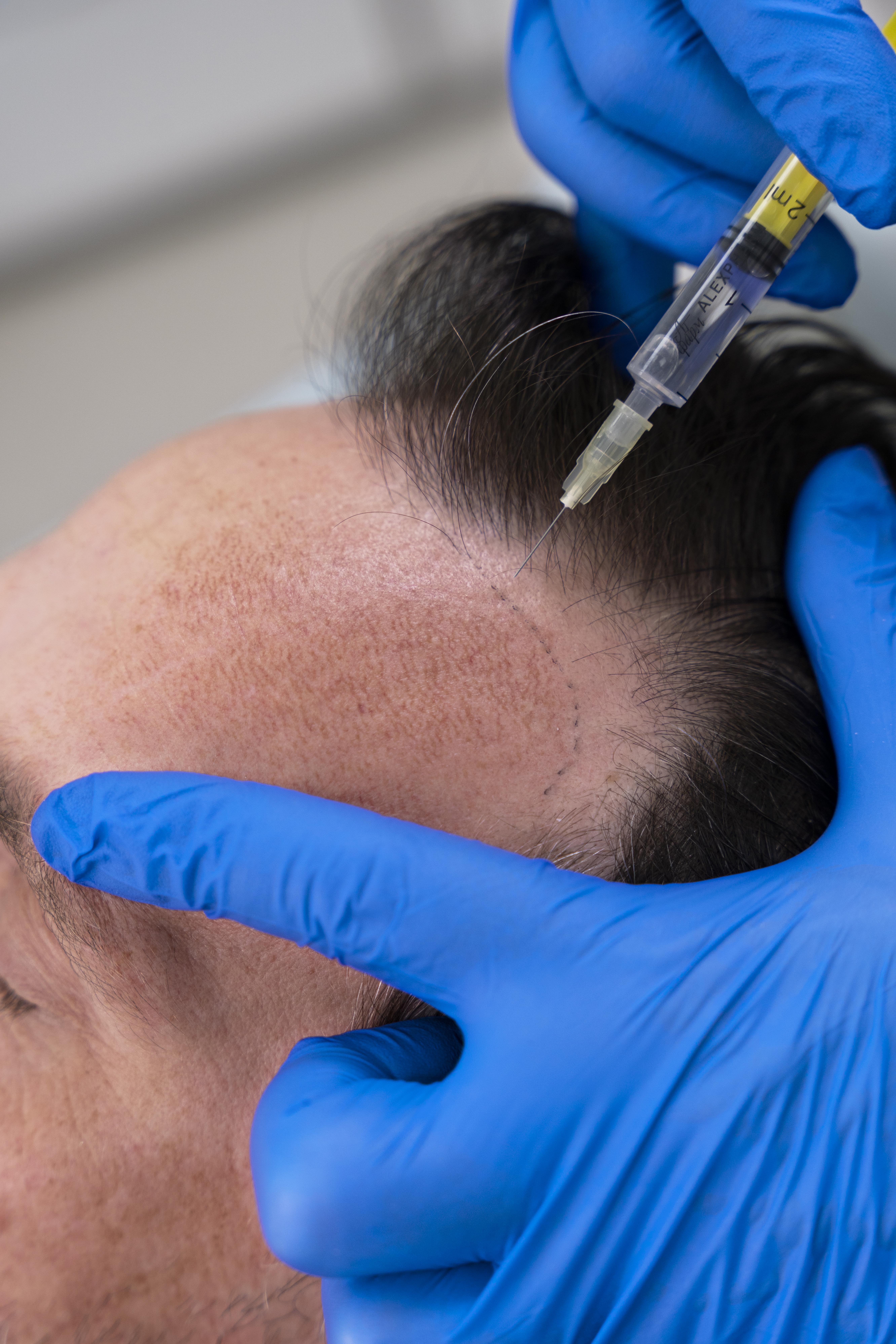 Hair Transplant in Madurai, hair clinic in Madurai, Skin Care in Madurai, Laser Treatment in Madurai, Hair Care in Madurai, hydra facial in Madurai, Hair Transplant near me, hair clinic near me, Skin Care near me, Hair Transplant in Madurai, best hair clinic in Madurai, best hydra facial in Madurai,  best hair transplantation clinic in madurai, best laser unwanted hair removal in Madurai, Best Hair Restoration in Madurai, Best Hair Replacement in Madurai, Best Hair Transplant Surgery in Madurai, Best Hair Loss Treatment in Madurai, Best Hair Grafting in Madurai, Best Hair Regrowth in Madurai, Best Hair Loss Solutions in Madurai, Best Hair Transplant Clinics in Madurai, Best Baldness Treatment in Madurai, Best Hair Transplant Recovery in Madurai, Best Hair Transplant Cost in Madurai, Best Hairline Restoration in Madurai, Best Scalp Treatments in Madurai, Best Hair Thinning Solutions in Madurai, Best skin clinic in madurai, Best laser treatment in madurai, best acne scar treatment in madurai, Best chemical peels in madurai , Best laser tattoo removal clinic in madurai , Best hair fall treatment clinic in madurai , best laser skin rejuvenation clinic in madurai , Best laser scar reduction clinic in madurai, best skin brightening treatment in Madurai, Best Hair Regrowth in Madurai, Best Hair Loss Solutions in Madurai, Best Hair Transplant Clinics in Madurai, Best Baldness Treatment in Madurai, Best Hair Transplant Recovery in Madurai, Best Hair Transplant Cost in Madurai, Best Hairline Restoration in Madurai, Best Scalp Treatments in Madurai, Best Hair Thinning Solutions in Madurai, Best Hair Transplant Before and After in Madurai, Best Hair Transplant Consultation in Madurai, Laser Hair Removal in Madurai, Laser Skin Therapy in Madurai, Laser Skin Resurfacing in Madurai, Best Follicular Unit Transplantation (FUT) in Madurai, Best Follicular Unit Extraction (FUE) in Madurai, Best Scalp Micropigmentation in Madurai, Best  Dark Circle Solutions in Madurai, Black Eye Treatment  in Madurai, Best Beauty Therapist in Madurai, Color-Centric Skincare in Madurai, Hue-Based Skin Treatment in Madurai, Skincare for All Hues in Madurai, Skin Care for Diverse Hues in Madurai, Skin Tone-Specific Treatments in Madurai, Skincare Solutions for Every Hue in Madurai, Hue-Specific Dermatology in Madurai, Skincare by Skin Tone in Madurai, Tailored Skin Treatment for Hues in Madurai, Personalized Skincare by Hues in Madurai, Skin Care for Various Hues in Madurai, Color-Based Skin Care in Madurai, Skin Health for All Tones in Madurai, Laser Skin Tightening in Madurai, Laser Wrinkle Reduction in Madurai, Laser Scar Removal in Madurai, Laser Pigmentation Treatment in Madurai, Laser Acne Treatment in Madurai, Laser Skin Rejuvenation in Madurai, Laser Tattoo Removal in Madurai, Non-Invasive Laser Treatment in Madurai, Laser Skin Care in Madurai, Medical Laser Treatment in Madurai, Laser Dermatology in Madurai, Advanced Laser Therapy in Madurai, Cosmetic Laser Procedures in Madurai, Laser Anti-Aging in Madurai, Fractional Laser Treatment in Madurai, Laser Treatment Recovery in Madurai, Hair Treatment in Madurai, Hair Restoration in Madurai, Hair Health in Madurai, Hair Growth in Madurai, Hair Repair in Madurai, Hair Loss Prevention in Madurai, Hair Conditioning in Madurai, Hair Strengthening in Madurai, Scalp Treatment in Madurai, Hair Moisturization in Madurai, Split Ends Repair in Madurai, Natural Hair Treatments in Madurai, Hair Coloring in Madurai, Heat Damage Repair in Madurai, Hair Masks in Madurai, Organic Hair Care in Madurai, Hair Shine in Madurai, Frizz Control in Madurai, Hair Serums in Madurai.