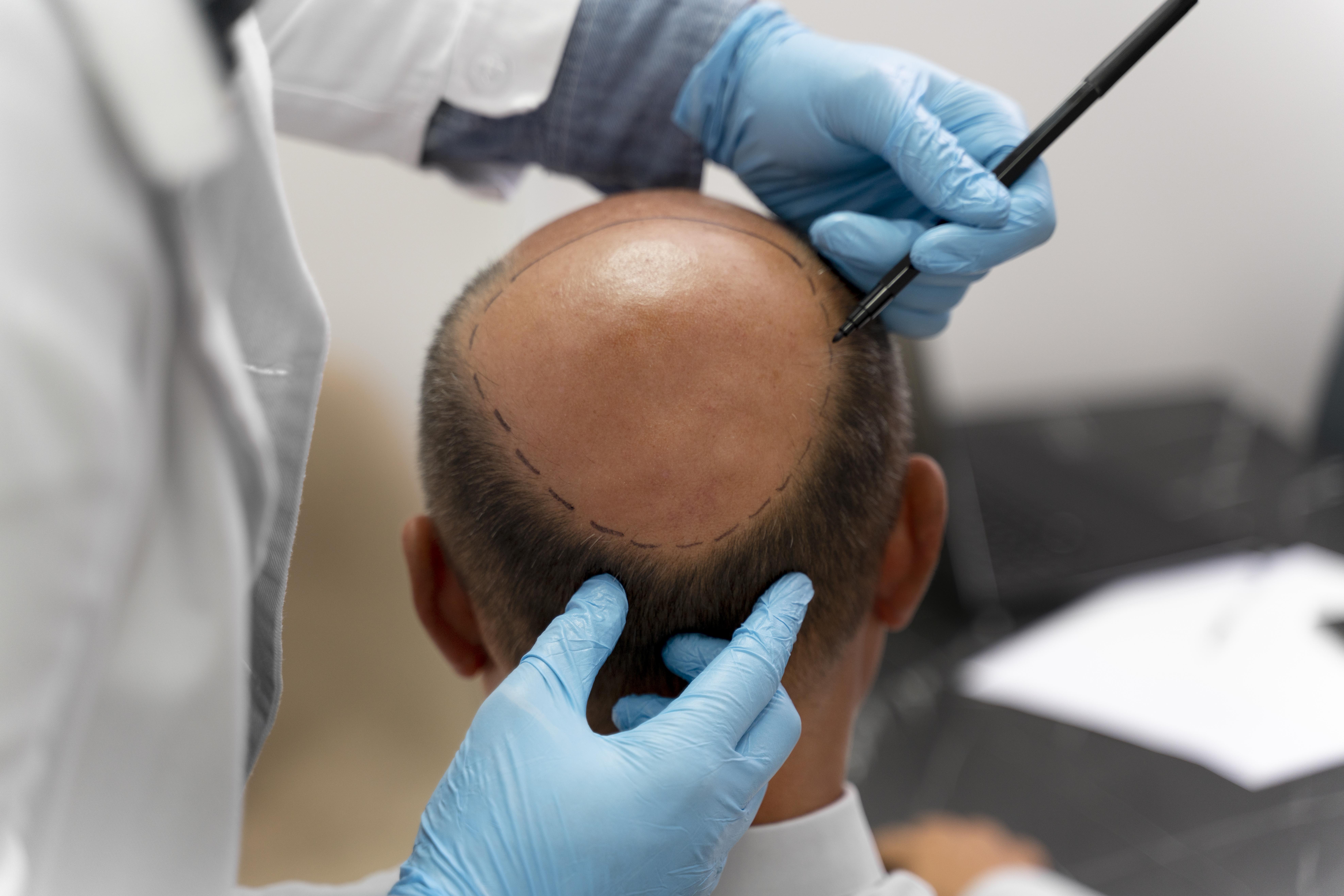 Hair Transplant in Madurai, hair clinic in Madurai, Skin Care in Madurai, Laser Treatment in Madurai, Hair Care in Madurai, hydra facial in Madurai, Hair Transplant near me, hair clinic near me, Skin Care near me, Hair Transplant in Madurai, best hair clinic in Madurai, best hydra facial in Madurai,  best hair transplantation clinic in madurai, best laser unwanted hair removal in Madurai, Best Hair Restoration in Madurai, Best Hair Replacement in Madurai, Best Hair Transplant Surgery in Madurai, Best Hair Loss Treatment in Madurai, Best Hair Grafting in Madurai, Best Hair Regrowth in Madurai, Best Hair Loss Solutions in Madurai, Best Hair Transplant Clinics in Madurai, Best Baldness Treatment in Madurai, Best Hair Transplant Recovery in Madurai, Best Hair Transplant Cost in Madurai, Best Hairline Restoration in Madurai, Best Scalp Treatments in Madurai, Best Hair Thinning Solutions in Madurai, Best skin clinic in madurai, Best laser treatment in madurai, best acne scar treatment in madurai, Best chemical peels in madurai , Best laser tattoo removal clinic in madurai , Best hair fall treatment clinic in madurai , best laser skin rejuvenation clinic in madurai , Best laser scar reduction clinic in madurai, best skin brightening treatment in Madurai, Best Hair Regrowth in Madurai, Best Hair Loss Solutions in Madurai, Best Hair Transplant Clinics in Madurai, Best Baldness Treatment in Madurai, Best Hair Transplant Recovery in Madurai, Best Hair Transplant Cost in Madurai, Best Hairline Restoration in Madurai, Best Scalp Treatments in Madurai, Best Hair Thinning Solutions in Madurai, Best Hair Transplant Before and After in Madurai, Best Hair Transplant Consultation in Madurai, Laser Hair Removal in Madurai, Laser Skin Therapy in Madurai, Laser Skin Resurfacing in Madurai, Best Follicular Unit Transplantation (FUT) in Madurai, Best Follicular Unit Extraction (FUE) in Madurai, Best Scalp Micropigmentation in Madurai, Best  Dark Circle Solutions in Madurai, Black Eye Treatment  in Madurai, Best Beauty Therapist in Madurai, Color-Centric Skincare in Madurai, Hue-Based Skin Treatment in Madurai, Skincare for All Hues in Madurai, Skin Care for Diverse Hues in Madurai, Skin Tone-Specific Treatments in Madurai, Skincare Solutions for Every Hue in Madurai, Hue-Specific Dermatology in Madurai, Skincare by Skin Tone in Madurai, Tailored Skin Treatment for Hues in Madurai, Personalized Skincare by Hues in Madurai, Skin Care for Various Hues in Madurai, Color-Based Skin Care in Madurai, Skin Health for All Tones in Madurai, Laser Skin Tightening in Madurai, Laser Wrinkle Reduction in Madurai, Laser Scar Removal in Madurai, Laser Pigmentation Treatment in Madurai, Laser Acne Treatment in Madurai, Laser Skin Rejuvenation in Madurai, Laser Tattoo Removal in Madurai, Non-Invasive Laser Treatment in Madurai, Laser Skin Care in Madurai, Medical Laser Treatment in Madurai, Laser Dermatology in Madurai, Advanced Laser Therapy in Madurai, Cosmetic Laser Procedures in Madurai, Laser Anti-Aging in Madurai, Fractional Laser Treatment in Madurai, Laser Treatment Recovery in Madurai, Hair Treatment in Madurai, Hair Restoration in Madurai, Hair Health in Madurai, Hair Growth in Madurai, Hair Repair in Madurai, Hair Loss Prevention in Madurai, Hair Conditioning in Madurai, Hair Strengthening in Madurai, Scalp Treatment in Madurai, Hair Moisturization in Madurai, Split Ends Repair in Madurai, Natural Hair Treatments in Madurai, Hair Coloring in Madurai, Heat Damage Repair in Madurai, Hair Masks in Madurai, Organic Hair Care in Madurai, Hair Shine in Madurai, Frizz Control in Madurai, Hair Serums in Madurai.