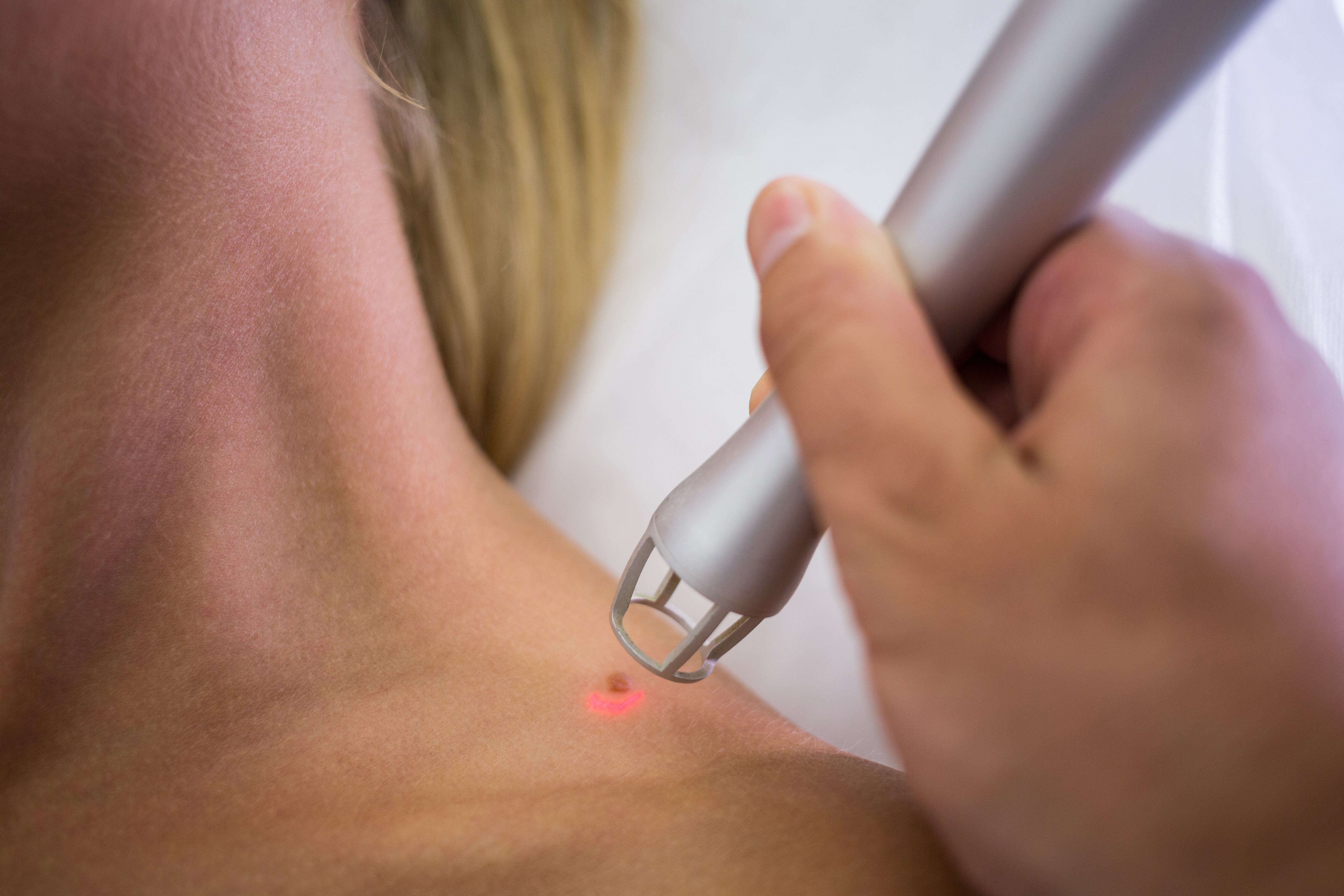 Hair Transplant in Madurai, hair clinic in Madurai, Skin Care in Madurai, Laser Treatment in Madurai, Hair Care in Madurai, hydra facial in Madurai, Hair Transplant near me, hair clinic near me, Skin Care near me, Hair Transplant in Madurai, best hair clinic in Madurai, best hydra facial in Madurai,  best hair transplantation clinic in madurai, best laser unwanted hair removal in Madurai, Best Hair Restoration in Madurai, Best Hair Replacement in Madurai, Best Hair Transplant Surgery in Madurai, Best Hair Loss Treatment in Madurai, Best Hair Grafting in Madurai, Best Hair Regrowth in Madurai, Best Hair Loss Solutions in Madurai, Best Hair Transplant Clinics in Madurai, Best Baldness Treatment in Madurai, Best Hair Transplant Recovery in Madurai, Best Hair Transplant Cost in Madurai, Best Hairline Restoration in Madurai, Best Scalp Treatments in Madurai, Best Hair Thinning Solutions in Madurai, Best skin clinic in madurai, Best laser treatment in madurai, best acne scar treatment in madurai, Best chemical peels in madurai , Best laser tattoo removal clinic in madurai , Best hair fall treatment clinic in madurai , best laser skin rejuvenation clinic in madurai , Best laser scar reduction clinic in madurai, best skin brightening treatment in Madurai, Best Hair Regrowth in Madurai, Best Hair Loss Solutions in Madurai, Best Hair Transplant Clinics in Madurai, Best Baldness Treatment in Madurai, Best Hair Transplant Recovery in Madurai, Best Hair Transplant Cost in Madurai, Best Hairline Restoration in Madurai, Best Scalp Treatments in Madurai, Best Hair Thinning Solutions in Madurai, Best Hair Transplant Before and After in Madurai, Best Hair Transplant Consultation in Madurai, Laser Hair Removal in Madurai, Laser Skin Therapy in Madurai, Laser Skin Resurfacing in Madurai, Best Follicular Unit Transplantation (FUT) in Madurai, Best Follicular Unit Extraction (FUE) in Madurai, Best Scalp Micropigmentation in Madurai, Best  Dark Circle Solutions in Madurai, Black Eye Treatment  in Madurai, Best Beauty Therapist in Madurai, Color-Centric Skincare in Madurai, Hue-Based Skin Treatment in Madurai, Skincare for All Hues in Madurai, Skin Care for Diverse Hues in Madurai, Skin Tone-Specific Treatments in Madurai, Skincare Solutions for Every Hue in Madurai, Hue-Specific Dermatology in Madurai, Skincare by Skin Tone in Madurai, Tailored Skin Treatment for Hues in Madurai, Personalized Skincare by Hues in Madurai, Skin Care for Various Hues in Madurai, Color-Based Skin Care in Madurai, Skin Health for All Tones in Madurai, Laser Skin Tightening in Madurai, Laser Wrinkle Reduction in Madurai, Laser Scar Removal in Madurai, Laser Pigmentation Treatment in Madurai, Laser Acne Treatment in Madurai, Laser Skin Rejuvenation in Madurai, Laser Tattoo Removal in Madurai, Non-Invasive Laser Treatment in Madurai, Laser Skin Care in Madurai, Medical Laser Treatment in Madurai, Laser Dermatology in Madurai, Advanced Laser Therapy in Madurai, Cosmetic Laser Procedures in Madurai, Laser Anti-Aging in Madurai, Fractional Laser Treatment in Madurai, Laser Treatment Recovery in Madurai, Hair Treatment in Madurai, Hair Restoration in Madurai, Hair Health in Madurai, Hair Growth in Madurai, Hair Repair in Madurai, Hair Loss Prevention in Madurai, Hair Conditioning in Madurai, Hair Strengthening in Madurai, Scalp Treatment in Madurai, Hair Moisturization in Madurai, Split Ends Repair in Madurai, Natural Hair Treatments in Madurai, Hair Coloring in Madurai, Heat Damage Repair in Madurai, Hair Masks in Madurai, Organic Hair Care in Madurai, Hair Shine in Madurai, Frizz Control in Madurai, Hair Serums in Madurai.