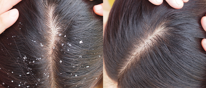 Hair Transplant in Madurai, hair clinic in Madurai, Skin Care in Madurai, Laser Treatment in Madurai, Hair Care in Madurai, hydra facial in Madurai, Hair Transplant near me, hair clinic near me, Skin Care near me, Hair Transplant in Madurai, best hair clinic in Madurai, best hydra facial in Madurai,  best hair transplantation clinic in madurai, best laser unwanted hair removal in Madurai, Best Hair Restoration in Madurai, Best Hair Replacement in Madurai, Best Hair Transplant Surgery in Madurai, Best Hair Loss Treatment in Madurai, Best Hair Grafting in Madurai, Best Hair Regrowth in Madurai, Best Hair Loss Solutions in Madurai, Best Hair Transplant Clinics in Madurai, Best Baldness Treatment in Madurai, Best Hair Transplant Recovery in Madurai, Best Hair Transplant Cost in Madurai, Best Hairline Restoration in Madurai, Best Scalp Treatments in Madurai, Best Hair Thinning Solutions in Madurai, Best skin clinic in madurai, Best laser treatment in madurai, best acne scar treatment in madurai, Best chemical peels in madurai , Best laser tattoo removal clinic in madurai , Best hair fall treatment clinic in madurai , best laser skin rejuvenation clinic in madurai , Best laser scar reduction clinic in madurai, best skin brightening treatment in Madurai, Best Hair Regrowth in Madurai, Best Hair Loss Solutions in Madurai, Best Hair Transplant Clinics in Madurai, Best Baldness Treatment in Madurai, Best Hair Transplant Recovery in Madurai, Best Hair Transplant Cost in Madurai, Best Hairline Restoration in Madurai, Best Scalp Treatments in Madurai, Best Hair Thinning Solutions in Madurai, Best Hair Transplant Before and After in Madurai, Best Hair Transplant Consultation in Madurai, Laser Hair Removal in Madurai, Laser Skin Therapy in Madurai, Laser Skin Resurfacing in Madurai, Best Follicular Unit Transplantation (FUT) in Madurai, Best Follicular Unit Extraction (FUE) in Madurai, Best Scalp Micropigmentation in Madurai, Best  Dark Circle Solutions in Madurai, Black Eye Treatment  in Madurai, Best Beauty Therapist in Madurai, Color-Centric Skincare in Madurai, Hue-Based Skin Treatment in Madurai, Skincare for All Hues in Madurai, Skin Care for Diverse Hues in Madurai, Skin Tone-Specific Treatments in Madurai, Skincare Solutions for Every Hue in Madurai, Hue-Specific Dermatology in Madurai, Skincare by Skin Tone in Madurai, Tailored Skin Treatment for Hues in Madurai, Personalized Skincare by Hues in Madurai, Skin Care for Various Hues in Madurai, Color-Based Skin Care in Madurai, Skin Health for All Tones in Madurai, Laser Skin Tightening in Madurai, Laser Wrinkle Reduction in Madurai, Laser Scar Removal in Madurai, Laser Pigmentation Treatment in Madurai, Laser Acne Treatment in Madurai, Laser Skin Rejuvenation in Madurai, Laser Tattoo Removal in Madurai, Non-Invasive Laser Treatment in Madurai, Laser Skin Care in Madurai, Medical Laser Treatment in Madurai, Laser Dermatology in Madurai, Advanced Laser Therapy in Madurai, Cosmetic Laser Procedures in Madurai, Laser Anti-Aging in Madurai, Fractional Laser Treatment in Madurai, Laser Treatment Recovery in Madurai, Hair Treatment in Madurai, Hair Restoration in Madurai, Hair Health in Madurai, Hair Growth in Madurai, Hair Repair in Madurai, Hair Loss Prevention in Madurai, Hair Conditioning in Madurai, Hair Strengthening in Madurai, Scalp Treatment in Madurai, Hair Moisturization in Madurai, Split Ends Repair in Madurai, Natural Hair Treatments in Madurai, Hair Coloring in Madurai, Heat Damage Repair in Madurai, Hair Masks in Madurai, Organic Hair Care in Madurai, Hair Shine in Madurai, Frizz Control in Madurai, Hair Serums in Madurai.
