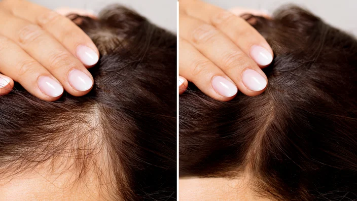 Hair Transplant in Madurai, hair clinic in Madurai, Skin Care in Madurai, Laser Treatment in Madurai, Hair Care in Madurai, hydra facial in Madurai, Hair Transplant near me, hair clinic near me, Skin Care near me, Hair Transplant in Madurai, best hair clinic in Madurai, best hydra facial in Madurai,  best hair transplantation clinic in madurai, best laser unwanted hair removal in Madurai, Best Hair Restoration in Madurai, Best Hair Replacement in Madurai, Best Hair Transplant Surgery in Madurai, Best Hair Loss Treatment in Madurai, Best Hair Grafting in Madurai, Best Hair Regrowth in Madurai, Best Hair Loss Solutions in Madurai, Best Hair Transplant Clinics in Madurai, Best Baldness Treatment in Madurai, Best Hair Transplant Recovery in Madurai, Best Hair Transplant Cost in Madurai, Best Hairline Restoration in Madurai, Best Scalp Treatments in Madurai, Best Hair Thinning Solutions in Madurai, Best skin clinic in madurai, Best laser treatment in madurai, best acne scar treatment in madurai, Best chemical peels in madurai , Best laser tattoo removal clinic in madurai , Best hair fall treatment clinic in madurai , best laser skin rejuvenation clinic in madurai , Best laser scar reduction clinic in madurai, best skin brightening treatment in Madurai, Best Hair Regrowth in Madurai, Best Hair Loss Solutions in Madurai, Best Hair Transplant Clinics in Madurai, Best Baldness Treatment in Madurai, Best Hair Transplant Recovery in Madurai, Best Hair Transplant Cost in Madurai, Best Hairline Restoration in Madurai, Best Scalp Treatments in Madurai, Best Hair Thinning Solutions in Madurai, Best Hair Transplant Before and After in Madurai, Best Hair Transplant Consultation in Madurai, Laser Hair Removal in Madurai, Laser Skin Therapy in Madurai, Laser Skin Resurfacing in Madurai, Best Follicular Unit Transplantation (FUT) in Madurai, Best Follicular Unit Extraction (FUE) in Madurai, Best Scalp Micropigmentation in Madurai, Best  Dark Circle Solutions in Madurai, Black Eye Treatment  in Madurai, Best Beauty Therapist in Madurai, Color-Centric Skincare in Madurai, Hue-Based Skin Treatment in Madurai, Skincare for All Hues in Madurai, Skin Care for Diverse Hues in Madurai, Skin Tone-Specific Treatments in Madurai, Skincare Solutions for Every Hue in Madurai, Hue-Specific Dermatology in Madurai, Skincare by Skin Tone in Madurai, Tailored Skin Treatment for Hues in Madurai, Personalized Skincare by Hues in Madurai, Skin Care for Various Hues in Madurai, Color-Based Skin Care in Madurai, Skin Health for All Tones in Madurai, Laser Skin Tightening in Madurai, Laser Wrinkle Reduction in Madurai, Laser Scar Removal in Madurai, Laser Pigmentation Treatment in Madurai, Laser Acne Treatment in Madurai, Laser Skin Rejuvenation in Madurai, Laser Tattoo Removal in Madurai, Non-Invasive Laser Treatment in Madurai, Laser Skin Care in Madurai, Medical Laser Treatment in Madurai, Laser Dermatology in Madurai, Advanced Laser Therapy in Madurai, Cosmetic Laser Procedures in Madurai, Laser Anti-Aging in Madurai, Fractional Laser Treatment in Madurai, Laser Treatment Recovery in Madurai, Hair Treatment in Madurai, Hair Restoration in Madurai, Hair Health in Madurai, Hair Growth in Madurai, Hair Repair in Madurai, Hair Loss Prevention in Madurai, Hair Conditioning in Madurai, Hair Strengthening in Madurai, Scalp Treatment in Madurai, Hair Moisturization in Madurai, Split Ends Repair in Madurai, Natural Hair Treatments in Madurai, Hair Coloring in Madurai, Heat Damage Repair in Madurai, Hair Masks in Madurai, Organic Hair Care in Madurai, Hair Shine in Madurai, Frizz Control in Madurai, Hair Serums in Madurai.