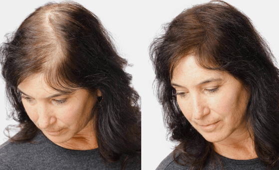 Hair Transplant in Madurai, hair clinic in Madurai, Skin Care in Madurai, Laser Treatment in Madurai, Hair Care in Madurai, hydra facial in Madurai, Hair Transplant near me, hair clinic near me, Skin Care near me, Hair Transplant in Madurai, best hair clinic in Madurai, best hydra facial in Madurai,  best hair transplantation clinic in madurai, best laser unwanted hair removal in Madurai, Best Hair Restoration in Madurai, Best Hair Replacement in Madurai, Best Hair Transplant Surgery in Madurai, Best Hair Loss Treatment in Madurai, Best Hair Grafting in Madurai, Best Hair Regrowth in Madurai, Best Hair Loss Solutions in Madurai, Best Hair Transplant Clinics in Madurai, Best Baldness Treatment in Madurai, Best Hair Transplant Recovery in Madurai, Best Hair Transplant Cost in Madurai, Best Hairline Restoration in Madurai, Best Scalp Treatments in Madurai, Best Hair Thinning Solutions in Madurai, Best skin clinic in madurai, Best laser treatment in madurai, best acne scar treatment in madurai, Best chemical peels in madurai , Best laser tattoo removal clinic in madurai , Best hair fall treatment clinic in madurai , best laser skin rejuvenation clinic in madurai , Best laser scar reduction clinic in madurai, best skin brightening treatment in Madurai, Best Hair Regrowth in Madurai, Best Hair Loss Solutions in Madurai, Best Hair Transplant Clinics in Madurai, Best Baldness Treatment in Madurai, Best Hair Transplant Recovery in Madurai, Best Hair Transplant Cost in Madurai, Best Hairline Restoration in Madurai, Best Scalp Treatments in Madurai, Best Hair Thinning Solutions in Madurai, Best Hair Transplant Before and After in Madurai, Best Hair Transplant Consultation in Madurai, Laser Hair Removal in Madurai, Laser Skin Therapy in Madurai, Laser Skin Resurfacing in Madurai, Best Follicular Unit Transplantation (FUT) in Madurai, Best Follicular Unit Extraction (FUE) in Madurai, Best Scalp Micropigmentation in Madurai, Best  Dark Circle Solutions in Madurai, Black Eye Treatment  in Madurai, Best Beauty Therapist in Madurai, Color-Centric Skincare in Madurai, Hue-Based Skin Treatment in Madurai, Skincare for All Hues in Madurai, Skin Care for Diverse Hues in Madurai, Skin Tone-Specific Treatments in Madurai, Skincare Solutions for Every Hue in Madurai, Hue-Specific Dermatology in Madurai, Skincare by Skin Tone in Madurai, Tailored Skin Treatment for Hues in Madurai, Personalized Skincare by Hues in Madurai, Skin Care for Various Hues in Madurai, Color-Based Skin Care in Madurai, Skin Health for All Tones in Madurai, Laser Skin Tightening in Madurai, Laser Wrinkle Reduction in Madurai, Laser Scar Removal in Madurai, Laser Pigmentation Treatment in Madurai, Laser Acne Treatment in Madurai, Laser Skin Rejuvenation in Madurai, Laser Tattoo Removal in Madurai, Non-Invasive Laser Treatment in Madurai, Laser Skin Care in Madurai, Medical Laser Treatment in Madurai, Laser Dermatology in Madurai, Advanced Laser Therapy in Madurai, Cosmetic Laser Procedures in Madurai, Laser Anti-Aging in Madurai, Fractional Laser Treatment in Madurai, Laser Treatment Recovery in Madurai, Hair Treatment in Madurai, Hair Restoration in Madurai, Hair Health in Madurai, Hair Growth in Madurai, Hair Repair in Madurai, Hair Loss Prevention in Madurai, Hair Conditioning in Madurai, Hair Strengthening in Madurai, Scalp Treatment in Madurai, Hair Moisturization in Madurai, Split Ends Repair in Madurai, Natural Hair Treatments in Madurai, Hair Coloring in Madurai, Heat Damage Repair in Madurai, Hair Masks in Madurai, Organic Hair Care in Madurai, Hair Shine in Madurai, Frizz Control in Madurai, Hair Serums in Madurai.