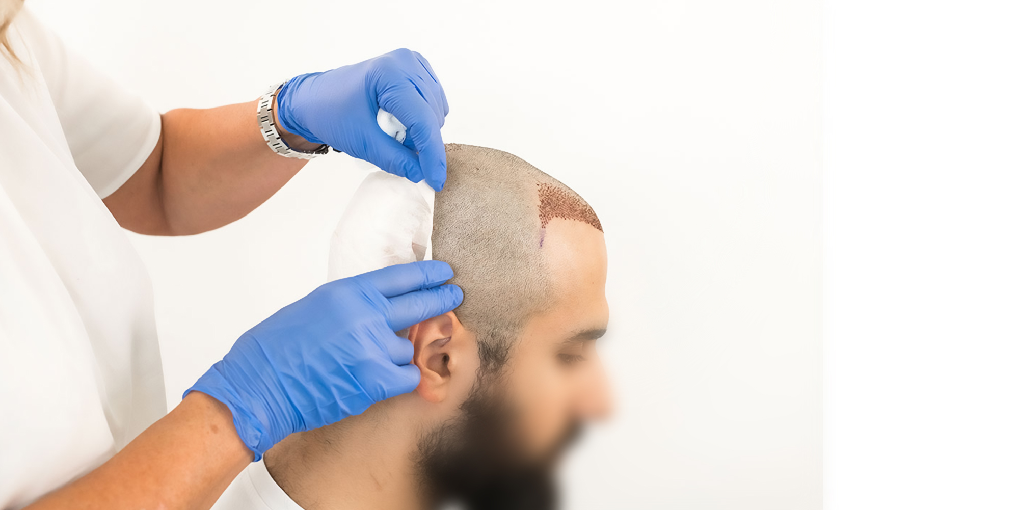 Hair Transplant in Madurai, hair clinic in Madurai, Skin Care in Madurai, Laser Treatment in Madurai, Hair Care in Madurai, hydra facial in Madurai, Hair Transplant near me, hair clinic near me, Skin Care near me, Hair Transplant in Madurai, best hair clinic in Madurai, best hydra facial in Madurai,  best hair transplantation clinic in madurai, best laser unwanted hair removal in Madurai, Best Hair Restoration in Madurai, Best Hair Replacement in Madurai, Best Hair Transplant Surgery in Madurai, Best Hair Loss Treatment in Madurai, Best Hair Grafting in Madurai, Best Hair Regrowth in Madurai, Best Hair Loss Solutions in Madurai, Best Hair Transplant Clinics in Madurai, Best Baldness Treatment in Madurai, Best Hair Transplant Recovery in Madurai, Best Hair Transplant Cost in Madurai, Best Hairline Restoration in Madurai, Best Scalp Treatments in Madurai, Best Hair Thinning Solutions in Madurai, Best skin clinic in madurai, Best laser treatment in madurai, best acne scar treatment in madurai, Best chemical peels in madurai , Best laser tattoo removal clinic in madurai , Best hair fall treatment clinic in madurai , best laser skin rejuvenation clinic in madurai , Best laser scar reduction clinic in madurai, best skin brightening treatment in Madurai, Best Hair Regrowth in Madurai, Best Hair Loss Solutions in Madurai, Best Hair Transplant Clinics in Madurai, Best Baldness Treatment in Madurai, Best Hair Transplant Recovery in Madurai, Best Hair Transplant Cost in Madurai, Best Hairline Restoration in Madurai, Best Scalp Treatments in Madurai, Best Hair Thinning Solutions in Madurai, Best Hair Transplant Before and After in Madurai, Best Hair Transplant Consultation in Madurai, Laser Hair Removal in Madurai, Laser Skin Therapy in Madurai, Laser Skin Resurfacing in Madurai, Best Follicular Unit Transplantation (FUT) in Madurai, Best Follicular Unit Extraction (FUE) in Madurai, Best Scalp Micropigmentation in Madurai, Best  Dark Circle Solutions in Madurai, Black Eye Treatment  in Madurai, Best Beauty Therapist in Madurai, Color-Centric Skincare in Madurai, Hue-Based Skin Treatment in Madurai, Skincare for All Hues in Madurai, Skin Care for Diverse Hues in Madurai, Skin Tone-Specific Treatments in Madurai, Skincare Solutions for Every Hue in Madurai, Hue-Specific Dermatology in Madurai, Skincare by Skin Tone in Madurai, Tailored Skin Treatment for Hues in Madurai, Personalized Skincare by Hues in Madurai, Skin Care for Various Hues in Madurai, Color-Based Skin Care in Madurai, Skin Health for All Tones in Madurai, Laser Skin Tightening in Madurai, Laser Wrinkle Reduction in Madurai, Laser Scar Removal in Madurai, Laser Pigmentation Treatment in Madurai, Laser Acne Treatment in Madurai, Laser Skin Rejuvenation in Madurai, Laser Tattoo Removal in Madurai, Non-Invasive Laser Treatment in Madurai, Laser Skin Care in Madurai, Medical Laser Treatment in Madurai, Laser Dermatology in Madurai, Advanced Laser Therapy in Madurai, Cosmetic Laser Procedures in Madurai, Laser Anti-Aging in Madurai, Fractional Laser Treatment in Madurai, Laser Treatment Recovery in Madurai, Hair Treatment in Madurai, Hair Restoration in Madurai, Hair Health in Madurai, Hair Growth in Madurai, Hair Repair in Madurai, Hair Loss Prevention in Madurai, Hair Conditioning in Madurai, Hair Strengthening in Madurai, Scalp Treatment in Madurai, Hair Moisturization in Madurai, Split Ends Repair in Madurai, Natural Hair Treatments in Madurai, Hair Coloring in Madurai, Heat Damage Repair in Madurai, Hair Masks in Madurai, Organic Hair Care in Madurai, Hair Shine in Madurai, Frizz Control in Madurai, Hair Serums in Madurai.
