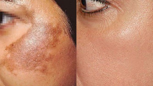 Hair Transplant in Madurai, hair clinic in Madurai, Skin Care in Madurai, Laser Treatment in Madurai, Hair Care in Madurai, hydra facial in Madurai, Hair Transplant near me, hair clinic near me, Skin Care near me, Hair Transplant in Madurai, best hair clinic in Madurai, best hydra facial in Madurai,  best hair transplantation clinic in madurai, best laser unwanted hair removal in Madurai, Best Hair Restoration in Madurai, Best Hair Replacement in Madurai, Best Hair Transplant Surgery in Madurai, Best Hair Loss Treatment in Madurai, Best Hair Grafting in Madurai, Best Hair Regrowth in Madurai, Best Hair Loss Solutions in Madurai, Best Hair Transplant Clinics in Madurai, Best Baldness Treatment in Madurai, Best Hair Transplant Recovery in Madurai, Best Hair Transplant Cost in Madurai, Best Hairline Restoration in Madurai, Best Scalp Treatments in Madurai, Best Hair Thinning Solutions in Madurai, Best skin clinic in madurai, Best laser treatment in madurai, best acne scar treatment in madurai, Best chemical peels in madurai , Best laser tattoo removal clinic in madurai , Best hair fall treatment clinic in madurai , best laser skin rejuvenation clinic in madurai , Best laser scar reduction clinic in madurai, best skin brightening treatment in Madurai, Best Hair Regrowth in Madurai, Best Hair Loss Solutions in Madurai, Best Hair Transplant Clinics in Madurai, Best Baldness Treatment in Madurai, Best Hair Transplant Recovery in Madurai, Best Hair Transplant Cost in Madurai, Best Hairline Restoration in Madurai, Best Scalp Treatments in Madurai, Best Hair Thinning Solutions in Madurai, Best Hair Transplant Before and After in Madurai, Best Hair Transplant Consultation in Madurai, Laser Hair Removal in Madurai, Laser Skin Therapy in Madurai, Laser Skin Resurfacing in Madurai, Best Follicular Unit Transplantation (FUT) in Madurai, Best Follicular Unit Extraction (FUE) in Madurai, Best Scalp Micropigmentation in Madurai, Best  Dark Circle Solutions in Madurai, Black Eye Treatment  in Madurai, Best Beauty Therapist in Madurai, Color-Centric Skincare in Madurai, Hue-Based Skin Treatment in Madurai, Skincare for All Hues in Madurai, Skin Care for Diverse Hues in Madurai, Skin Tone-Specific Treatments in Madurai, Skincare Solutions for Every Hue in Madurai, Hue-Specific Dermatology in Madurai, Skincare by Skin Tone in Madurai, Tailored Skin Treatment for Hues in Madurai, Personalized Skincare by Hues in Madurai, Skin Care for Various Hues in Madurai, Color-Based Skin Care in Madurai, Skin Health for All Tones in Madurai, Laser Skin Tightening in Madurai, Laser Wrinkle Reduction in Madurai, Laser Scar Removal in Madurai, Laser Pigmentation Treatment in Madurai, Laser Acne Treatment in Madurai, Laser Skin Rejuvenation in Madurai, Laser Tattoo Removal in Madurai, Non-Invasive Laser Treatment in Madurai, Laser Skin Care in Madurai, Medical Laser Treatment in Madurai, Laser Dermatology in Madurai, Advanced Laser Therapy in Madurai, Cosmetic Laser Procedures in Madurai, Laser Anti-Aging in Madurai, Fractional Laser Treatment in Madurai, Laser Treatment Recovery in Madurai, Hair Treatment in Madurai, Hair Restoration in Madurai, Hair Health in Madurai, Hair Growth in Madurai, Hair Repair in Madurai, Hair Loss Prevention in Madurai, Hair Conditioning in Madurai, Hair Strengthening in Madurai, Scalp Treatment in Madurai, Hair Moisturization in Madurai, Split Ends Repair in Madurai, Natural Hair Treatments in Madurai, Hair Coloring in Madurai, Heat Damage Repair in Madurai, Hair Masks in Madurai, Organic Hair Care in Madurai, Hair Shine in Madurai, Frizz Control in Madurai, Hair Serums in Madurai.